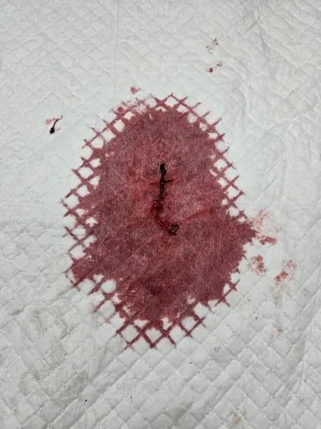 혈소판 수치 0에서 시작한 코코의 에반스증후군 치료 — 진료 사진 2