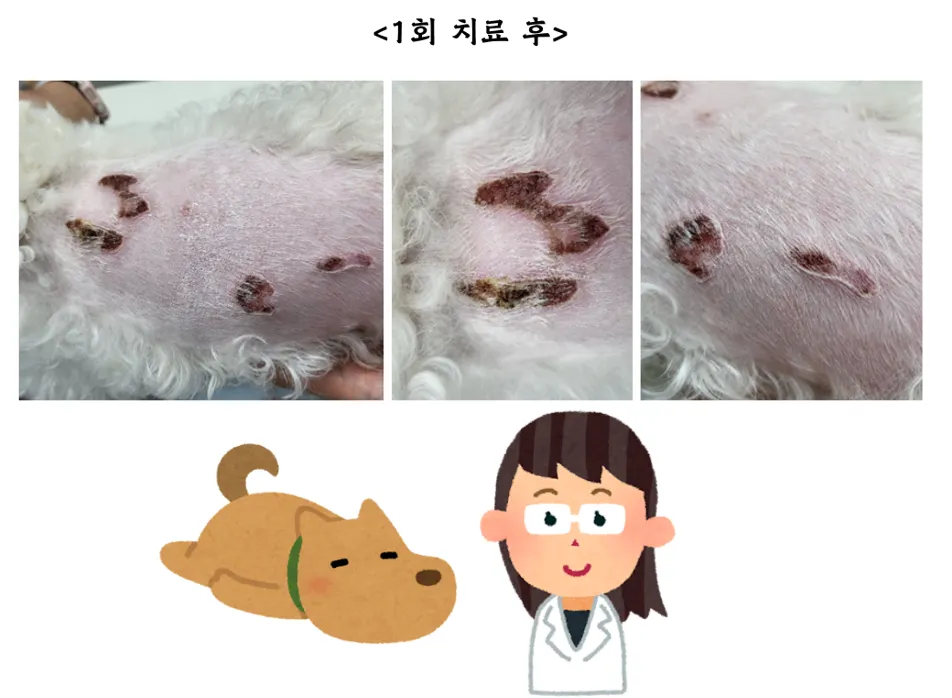 등에 넓은 화상을 입은 헤든이의 레이저 치료 12회 — 진료 사진 1