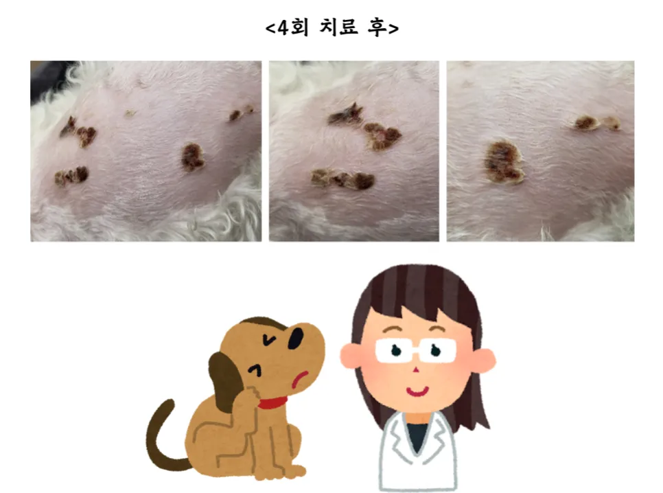 등에 넓은 화상을 입은 헤든이의 레이저 치료 12회 — 진료 사진 2