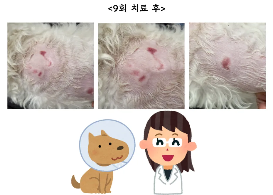 등에 넓은 화상을 입은 헤든이의 레이저 치료 12회 — 진료 사진 4